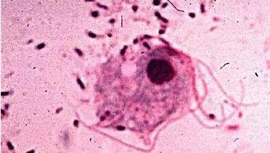 感染了滴虫性阴道炎的症状,感染滴虫性阴道炎的传播途径