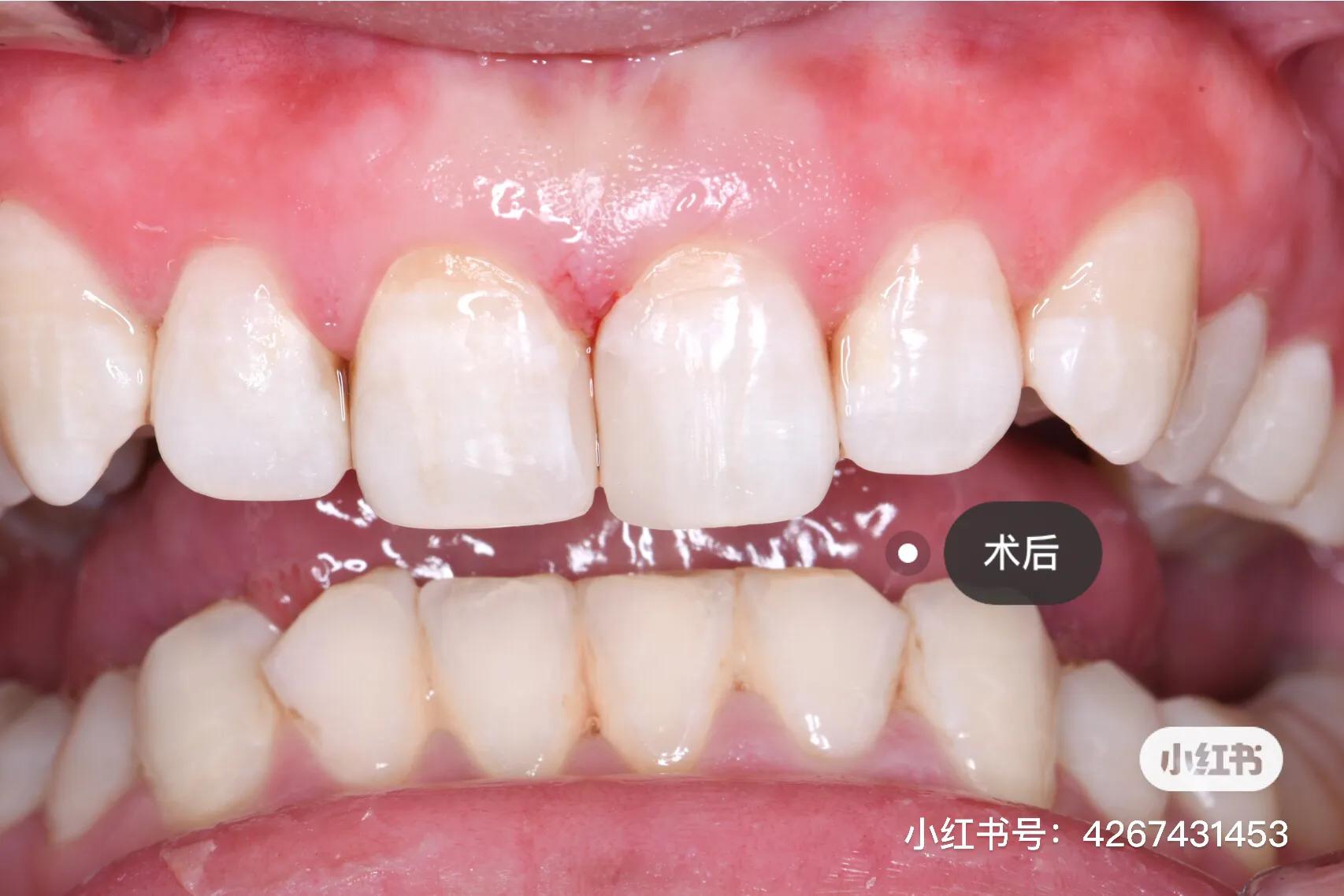 断牙修复,断牙修复病历