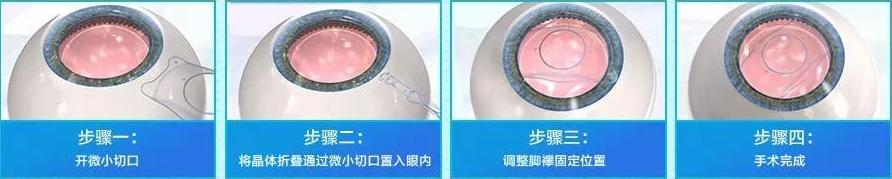 眼睛近视800度做激光后遗症,激光治疗近视散光有什么后遗症