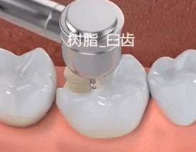 蛀牙补牙了材料老是会掉,为什么我补牙的材料是黑色的