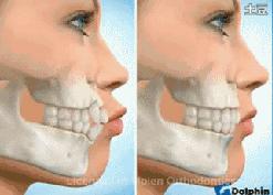 牙套只戴上面的行吗,刚戴牙套就不需要去医院吗