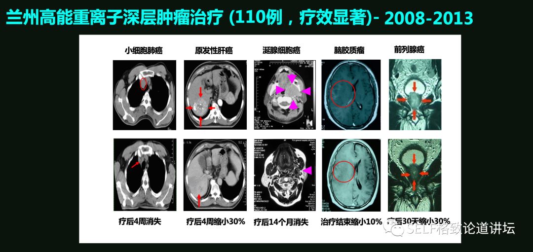 这个装置成功辅助我国两弹爆炸，现在它能治疗肿瘤