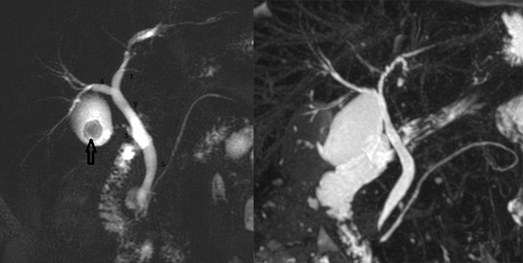 胆囊变异解剖图,胆道血供解剖