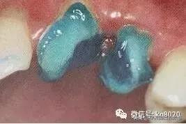 纤维桩的优点和缺点,看完这篇文章就明白了