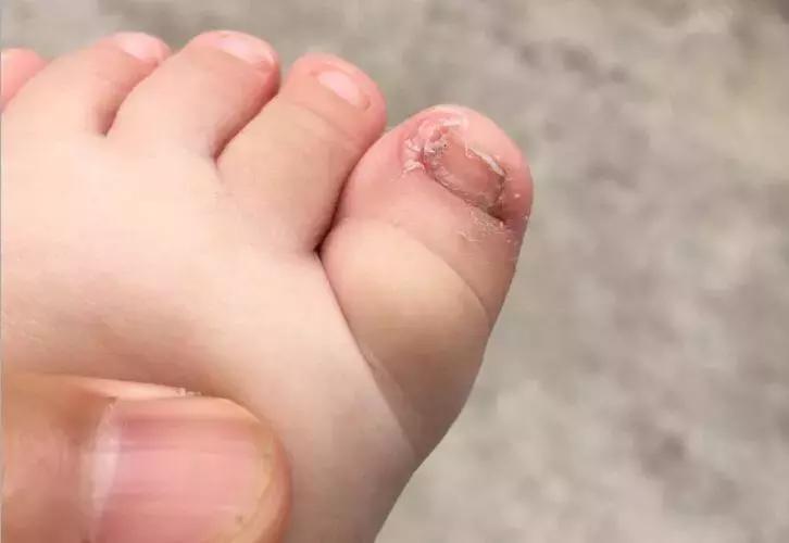 小朋友甲沟炎要拔掉整个指甲吗,小朋友甲沟炎怎么办