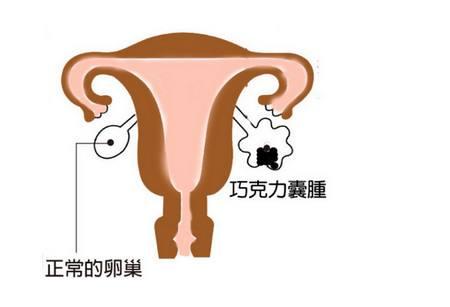有巧克力囊肿备孕要注意什么,巧克力囊肿4.2x3.5cm要做手术吗