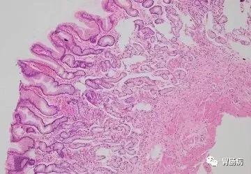 萎缩性胃炎与胃癌的关系,萎缩性胃炎与胃癌的症状区别