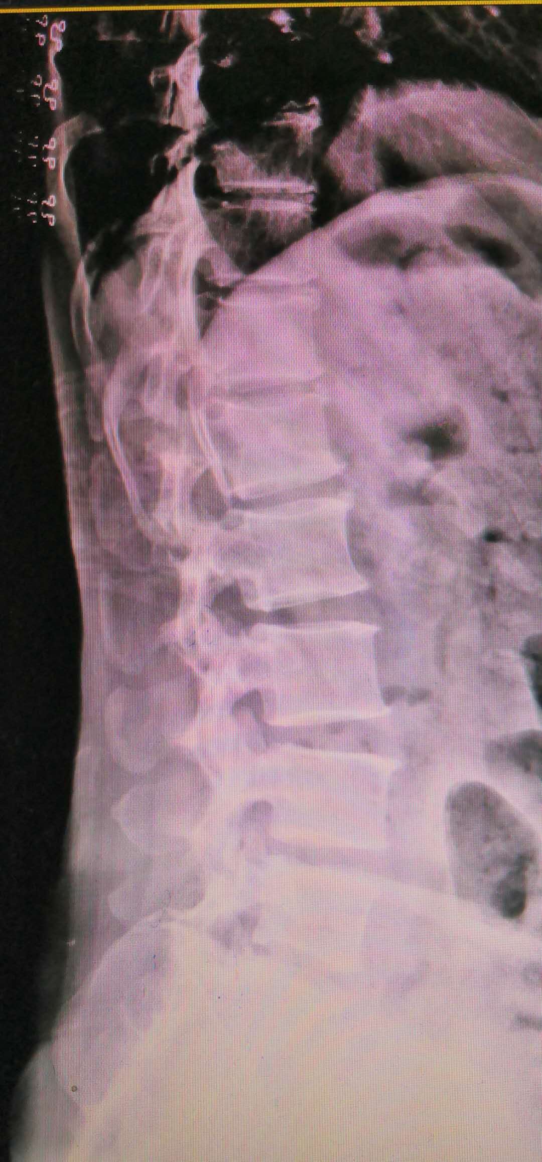 腰椎滑脱最终都要做手术么,为什么腰椎滑脱不建议手术
