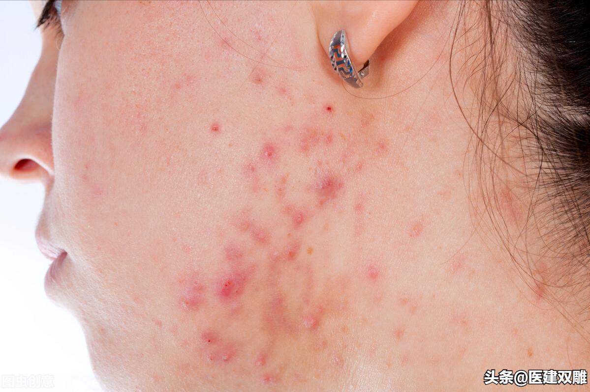 复方炉甘石抑菌洗剂都有什么妙用,炉甘石洗剂婴儿妙用