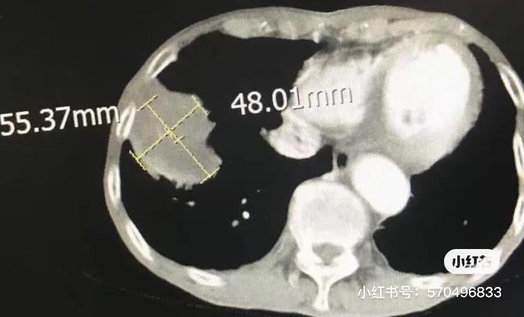 冷冻针治肿瘤能活多久,一根细针可以消除肿瘤