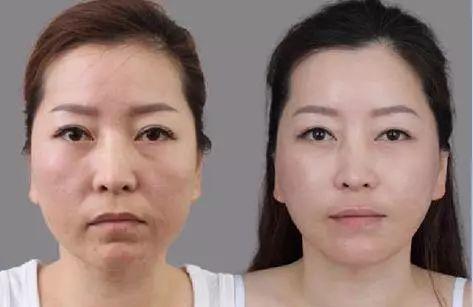 超声刀和热玛吉哪个提升效果好,超声刀和埋线提升哪个效果好