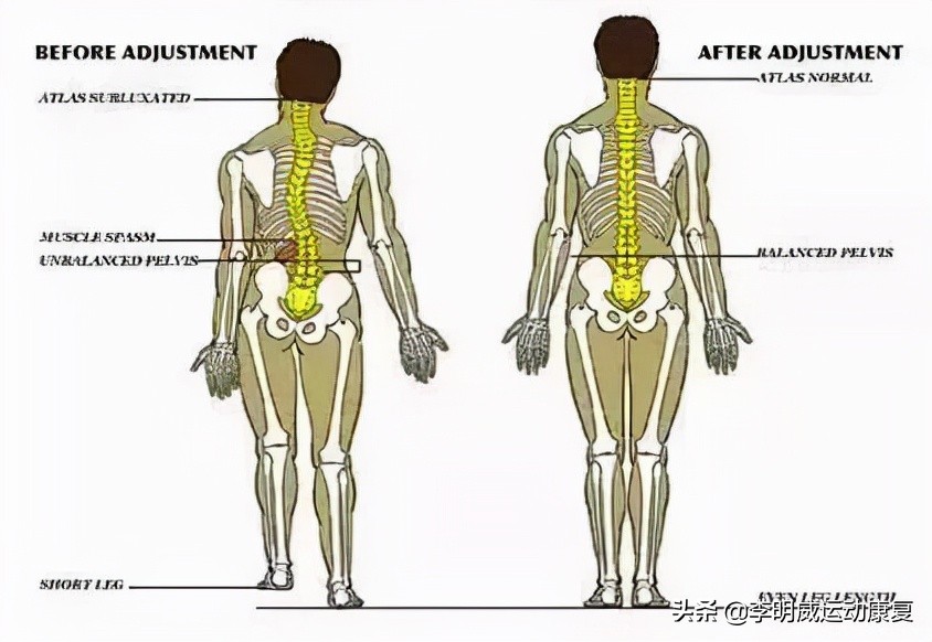 骨盆前倾骨盆不正怎么恢复,骨盆不正会造成什么后果