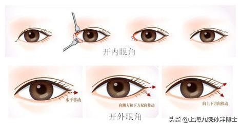 上海九院孙沣博士眼角修复,眼修复能找原来医生修复吗