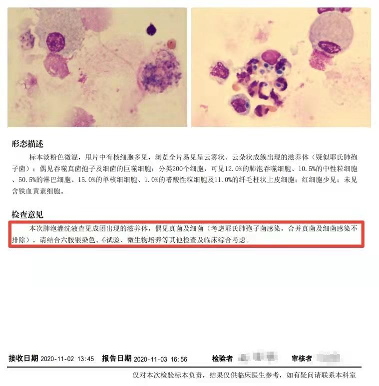 肺泡灌洗液细胞学检查“只需”看细胞吗？（续）