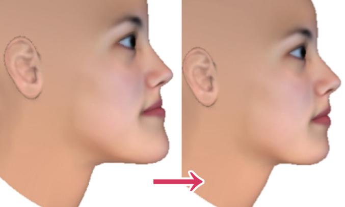 骨性地包天不做正颌手术最好方法,骨性地包天不做手术可矫正吗