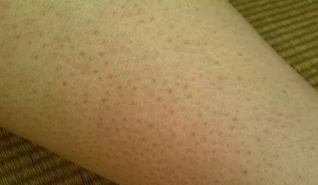 鸡皮疙瘩怎么拯救,治疗鸡皮肤最快的方法