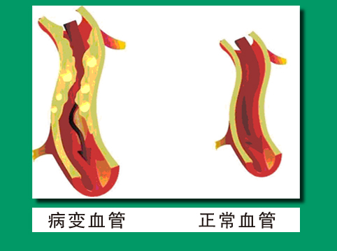 血管狭窄30%到50%是冠心病吗,冠心病人血管狭窄就是有斑块吗