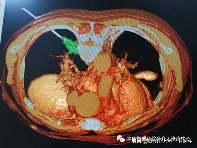 运城市第一医院肿瘤微创及综合介入科，特色技术—肿瘤穿刺活检术