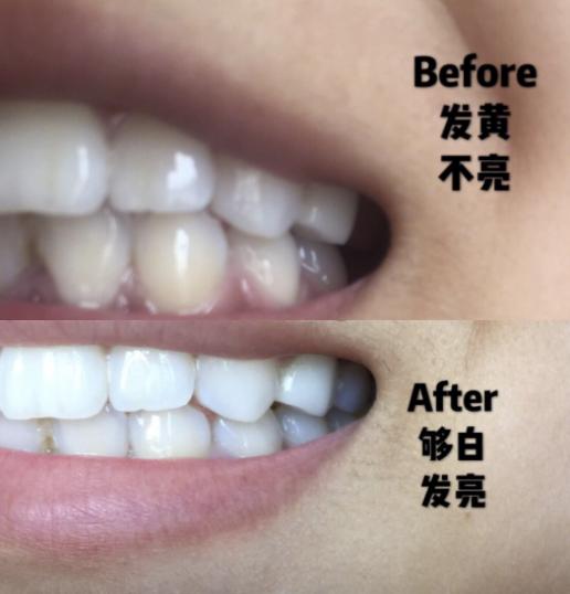 王子文白到发光的秘密,王子文牙齿美白