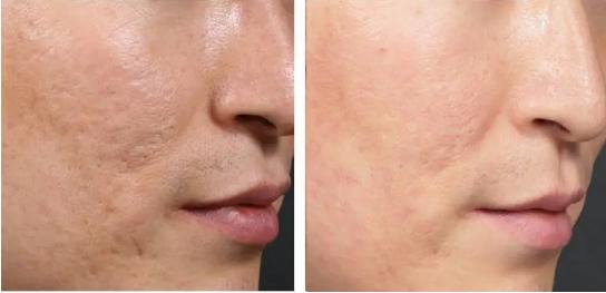 现在最流行医美项目是什么,公认比较有效的医美项目