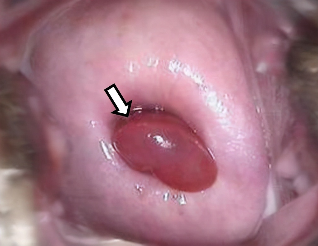 宫颈炎到底要不要治疗？