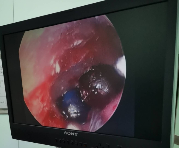 男童误把弹珠卡进鼻孔,男童弹珠塞入耳朵