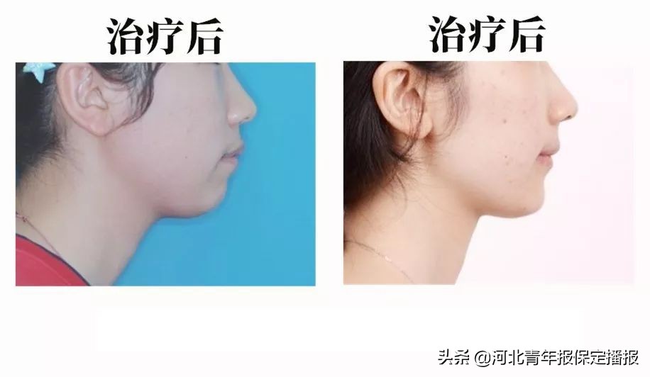 保定普通隐形牙套,保定隐形牙套矫正