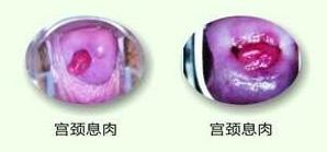 更年期出血是不是宫颈癌,妇科检查出血是宫颈癌吗