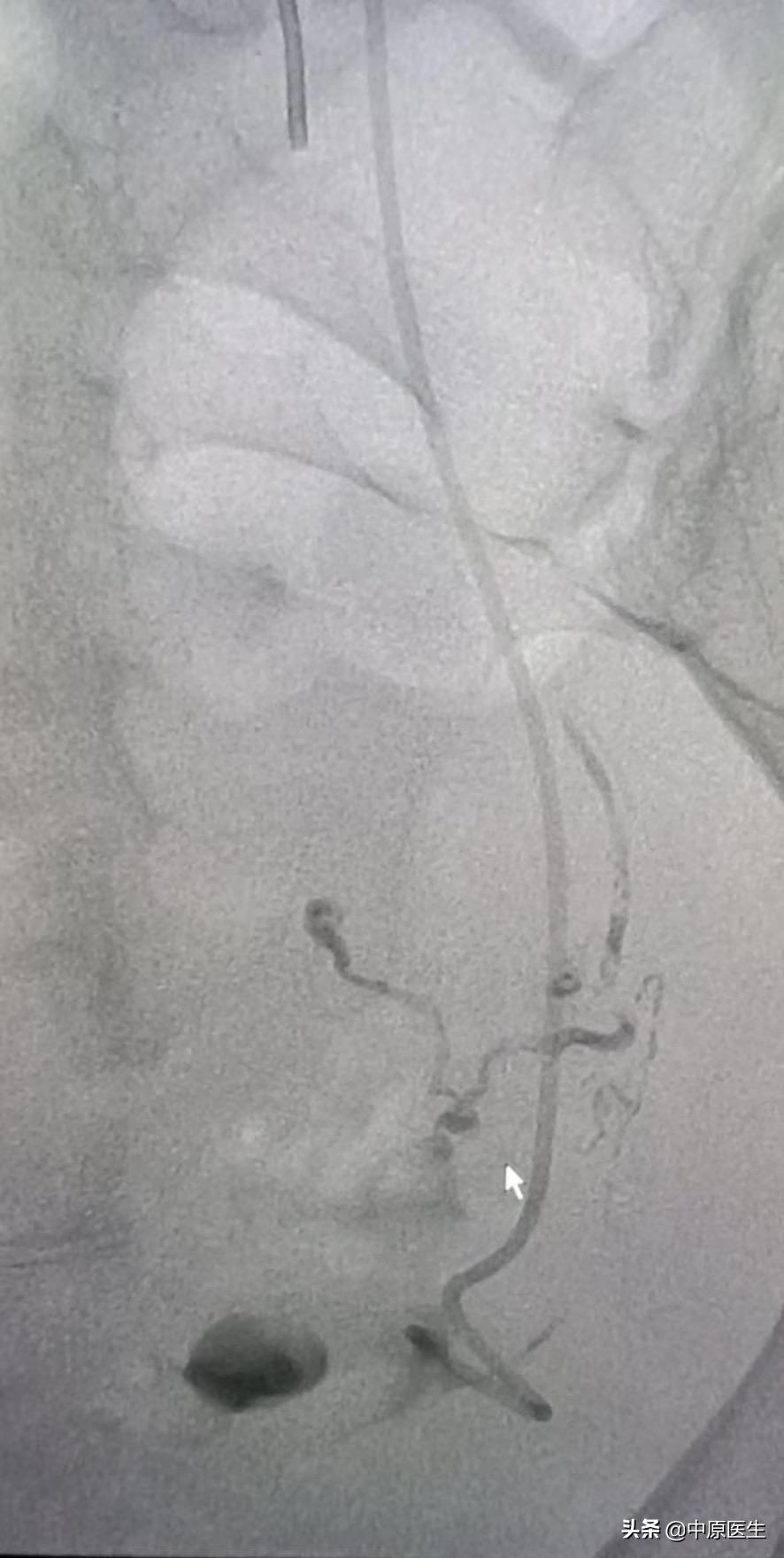 宫颈鳞癌需要切除哪里,宫颈鳞癌出血怎么处理