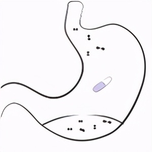 阿莫西林克拉维酸钾7:1什么意思,阿莫西林克拉维酸钾4:1用法用量