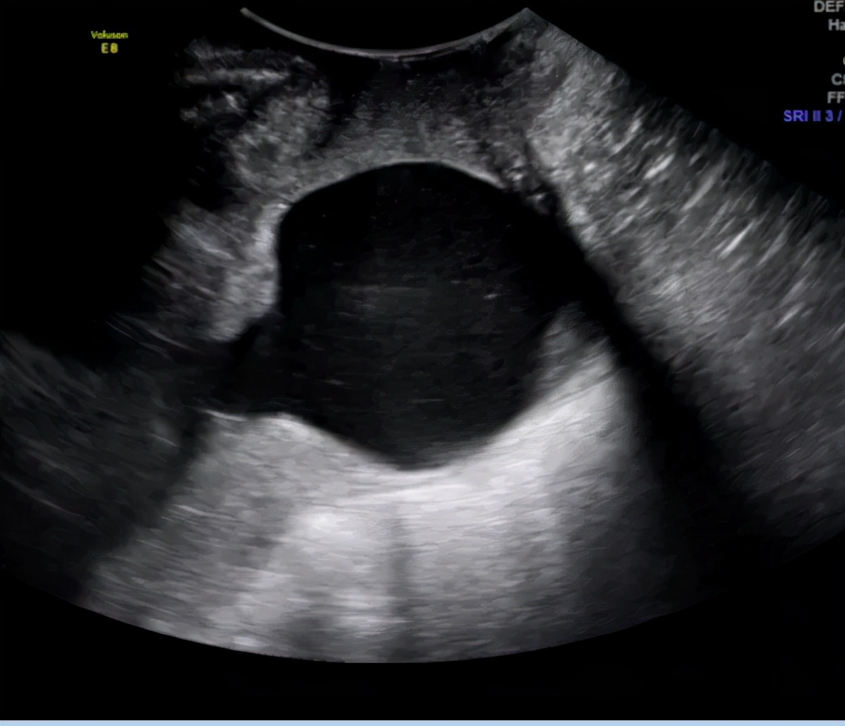 被大多数孕妈忽视的宫颈机能不全