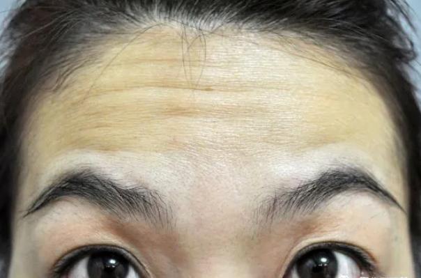 皱纹变多的症状,最近为什么突然有皱纹了