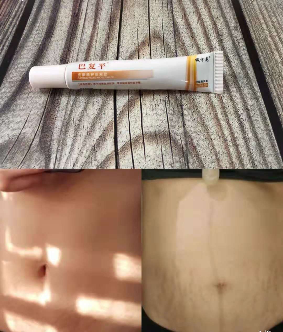 十几年妊娠纹祛疤痕最好的方法,祛疤祛妊娠纹用什么好