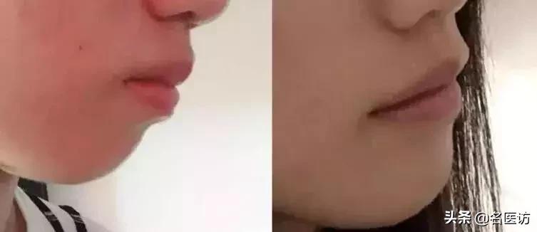 戴牙套2年不戴保持器反弹案例,戴牙套成功案例不戴保持器