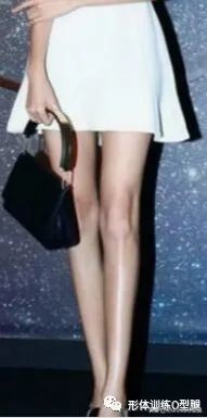 o型腿和罗圈腿图片对比,o型腿和罗圈腿的区别