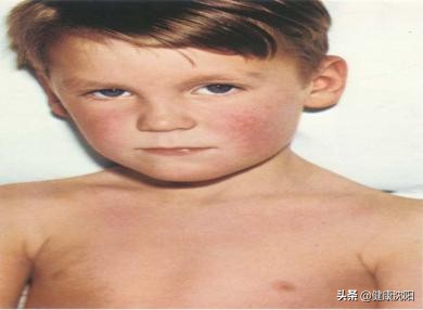 猩红热防控知识,呼吸道健康科普