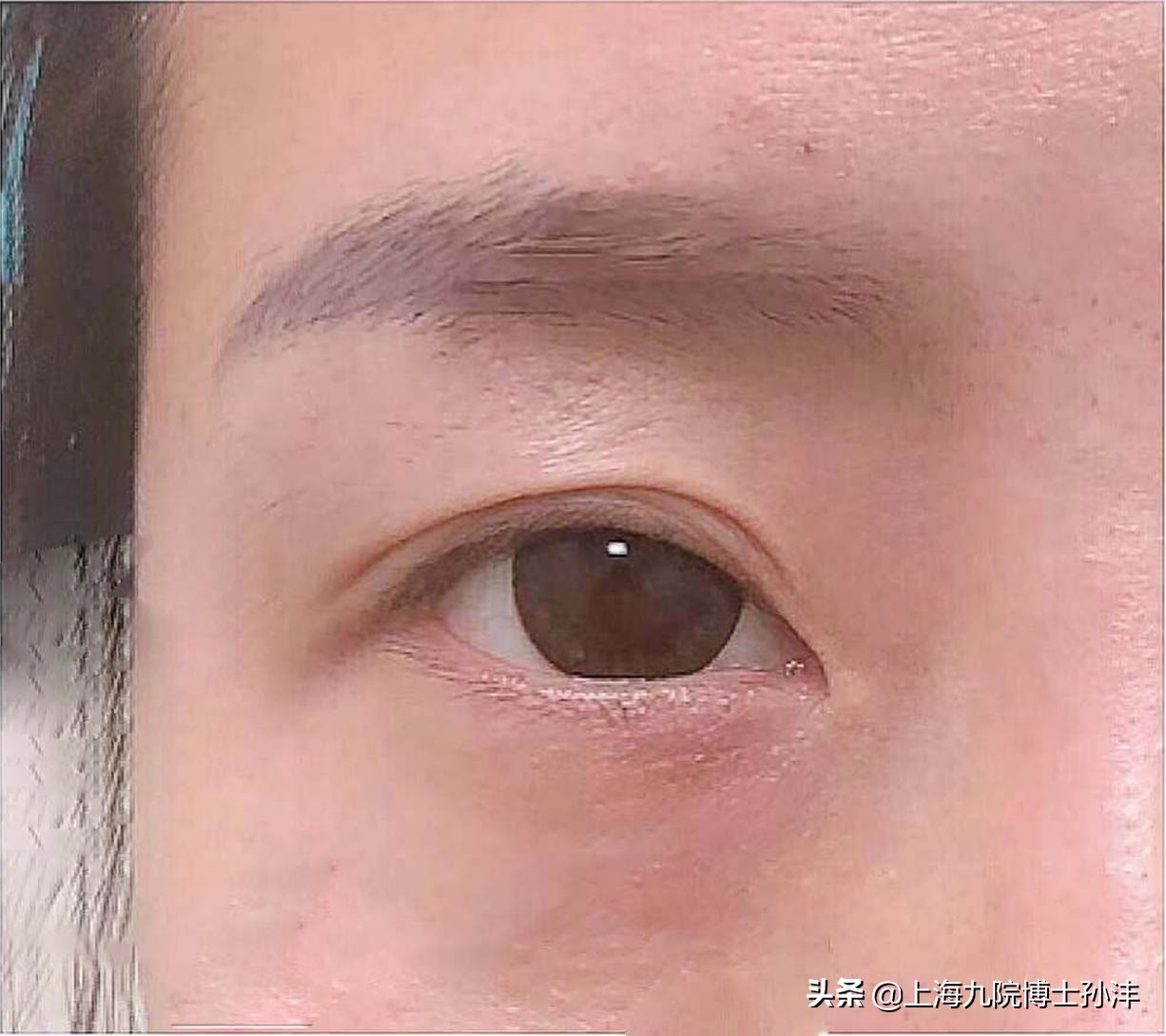 九院博士孙沣：眼部干瘪松弛线条凌乱，其实全切就能很好解决
