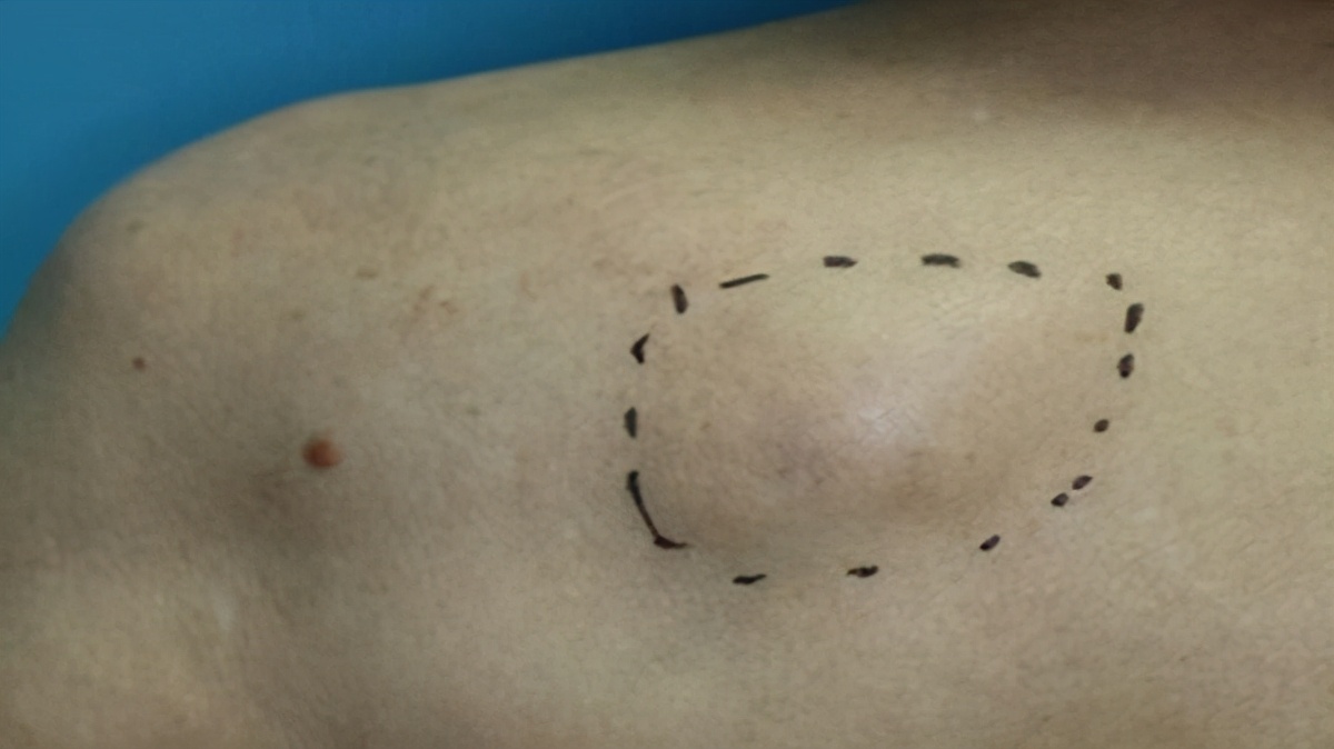 手术中的病理检查准确率高吗,手术病理