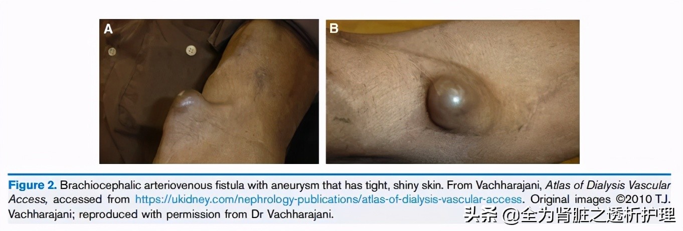 血透常见并发症及预防,血透常见报警原因及处理