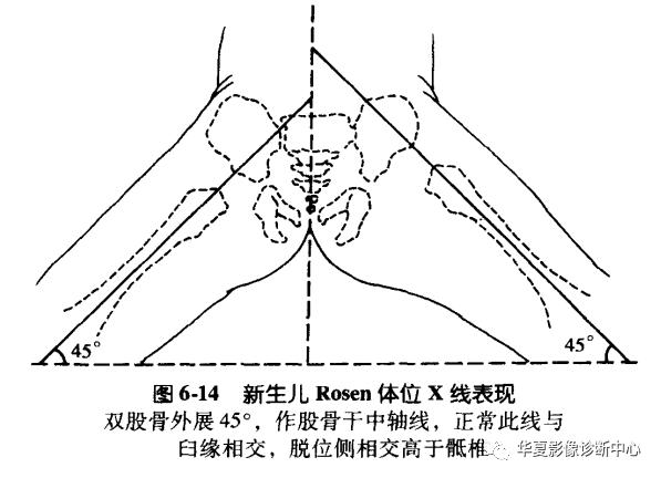 先天性髋关节脱位饮食,先天性髋关节脱位属不属于残疾人