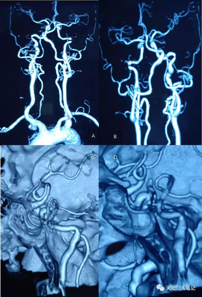 密网支架治疗脑动脉瘤术后效果图,密网支架治疗基底动脉假性动脉瘤