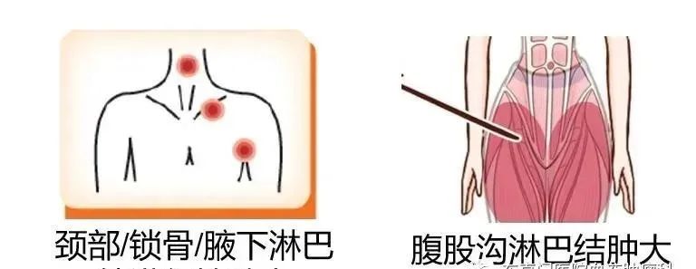 什么是淋巴瘤淋巴瘤有哪些症状,淋巴瘤的特征及治疗方法