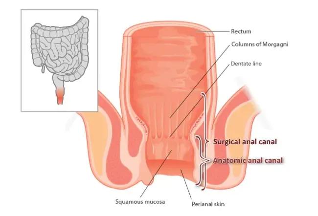 肛管癌与肛内尖锐性湿疣,肛管癌怎么检查能发现是肛管癌