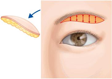 双眼皮全切加祛眼袋后1-7天恢复图,做完提眉去眼袋手术流泪