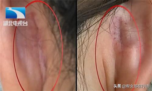 女子隆鼻失败要求免费修复被拒绝,女子隆鼻手术后感染