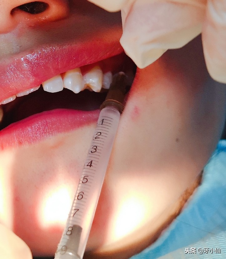 拔牙到底疼不疼几分钟能搞定,拔牙后很疼是伤到牙神经了吗