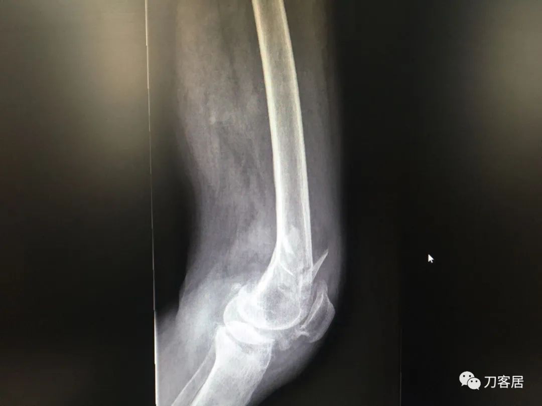 股骨胫骨骨折中医治疗方法,中药治疗股骨颈骨折