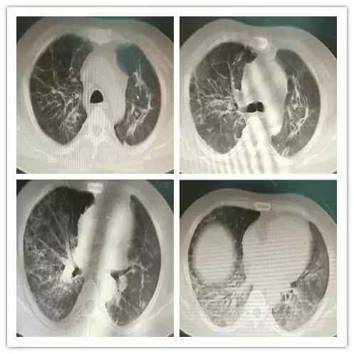 呼吸困难为主要症状的住院大病历,病人出现呼吸困难症状