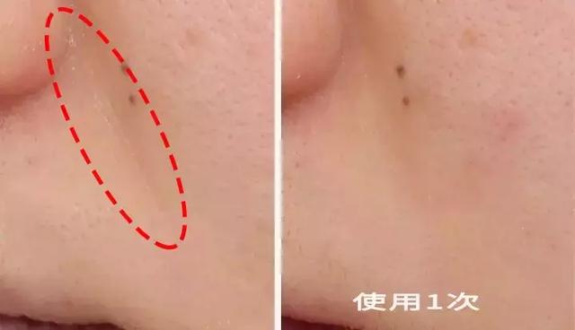 硬刚女皇龙妈也扛不住法令纹,2条沟壑让人心疼,贴一贴就消了