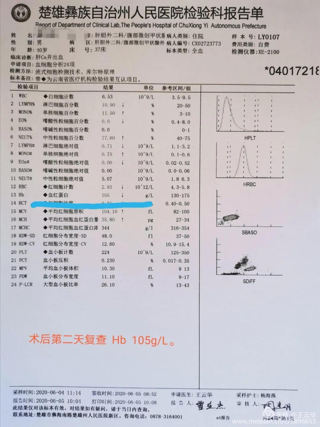 楚雄州人民医院肝胆外二科,四川省人民医院肝胆外科治疗肝癌